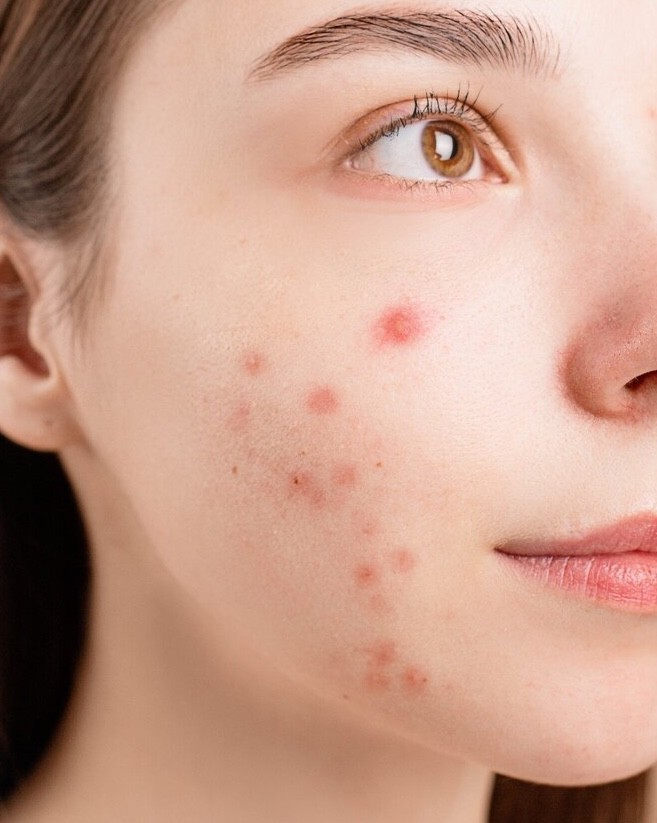 Why do these annoying pimples always appear at the most inconvenient moments, before important events and meetings?